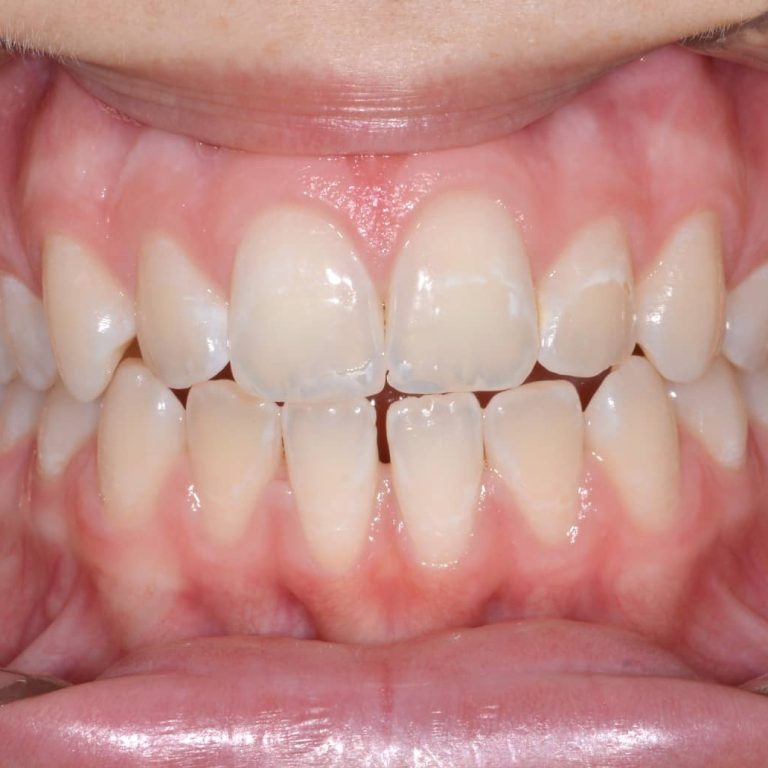 Dra Gabriela Aparicio - Invisalign Teen